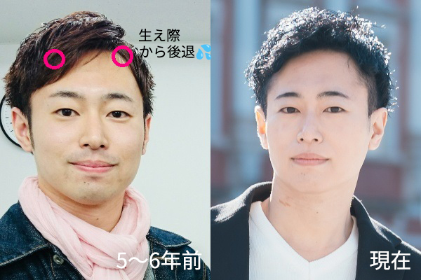 薄毛治療前と治療後の比較