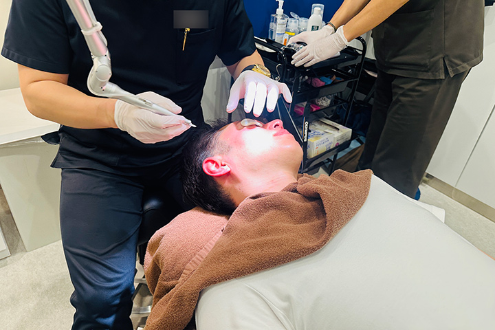 シミ取りレーザー（CO2レーザー）の施術模様