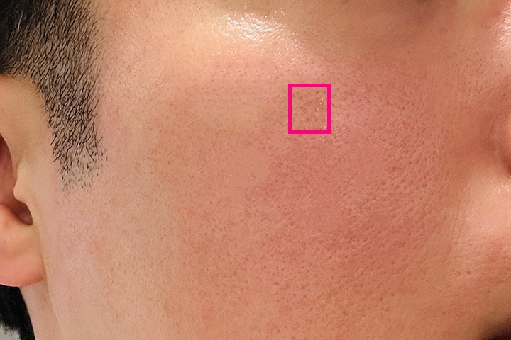 レーザー治療前の頬のシミ