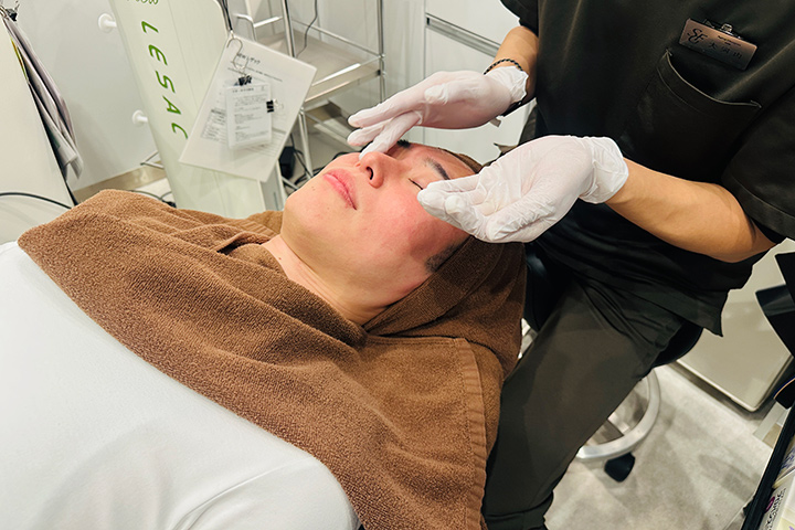 グリコール酸ピーリング施術の様子